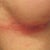 Allergic Reaction to Bacitracin