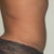 After TT-Side (6mths)