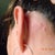 Behind left ear. Not as bad looking but the lump from the scar hurts when touched.