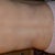 3 weeks with the back rolls gone but still swollen