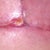Incision tear