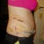 right side... SUPER bruised
