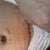 POD7 swelling more and more, peek at scar, first drain taken out, BB sutures removed