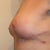 side view 2 weeks post lift and explant