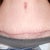 11 weeks post op.....going in next month and they will remove more skin and bring the scar down as well....