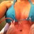 postop day two or three
475ml saline implants with tummy tuck