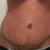 5 weeks post op insision