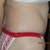 4 months post- op right side view