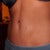 four months post op