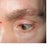 Louis W. Apostolakis, MD answers: Is it Possible to Raise Droopy Eyelid with Botox? (Photo)
