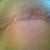 Wide scar as a result of staples used instead of stitches.