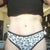 almost 7 months post op - With undies hiding the side bulges.  Not that bad.