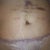 few wks after. still bruised