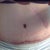 4 wks 2 days post op...
the scar to the side of belly button is my old gall bladder scar. That scar is going to be revised... meaning he will literally cut it out and restitch it to make it much more appealing looking..if a scar can be appealing!