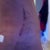 post-op day 3
