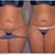 Front before and After