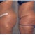 Side View- I think the before and after are reversed