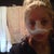 Right after surgery. Large circles under my eyes.