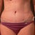 2 Week Post Op Front