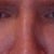 Louis W. Apostolakis, MD answers: Rhinoplasty following Septoplasty?