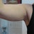 pre-op chubby arms