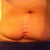 Pre TT..look at the lovely vertical appendectomy scar I've had since I was 17!
