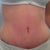 My new tummy 13 dpo! Still a bit of swelling but I have a normal belly button!