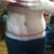 Swelling on my right hip. Pod 12