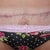 close up of tummy scar & you can see how much the right droops compared to the left. I have to lift skin to apply scar treatment...not happy about that :(