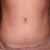 you can see the definition in my abs but you can also see the drooping tummy scar & lopsided navel scar as well as how the navel scar is around the navel & not tucked inside as I was told it would be :/