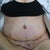After Surgery- The day drains where removed.