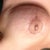 Day 19 left breast