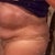 Pre tt after lipo side