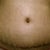 Day 9 PO. Close up of my belly button. Still has some dried blood/scabs in there to be cleaned up. Won't have a good idea of end result for a couple more weeks. Already looks better than what I had!