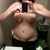 5 Days post op, hips have evened out. Breasts look different sizes but doc says it's due to swelling and not to worry.
