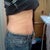 8 weeks post op side view