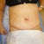1 week post op - swollen