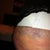 Hip has a bit of bruising