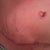 4-7-11 scar in front