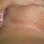 burning rash after 7 hours wearing clothes!
