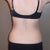 Back view before surgery.