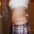 6 weeks post op