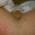 post op day 2; see where the paper tape irritated my skin - still sore after 5 days.