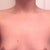 Post-op