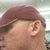 look at my lower chin, this it's like this on  both sides, he didnt go as far down as the first time, says there is no way he would have missed it, lower chin is one treatment, upper face is 2.