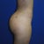 Wish Pic Side View- Got it from Dr. Jimerson's website- Patient #14