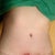 6 1/2 weeks PO - this is after my PS snipped away the skin that wasn't healing and left this hole that I'm packing with gauze - it will be sewed up this week some time.