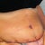 Close up of incision...hoping it will heal up nicely