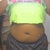 Day before surgery Front View