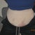 Day 1 after surgery front view